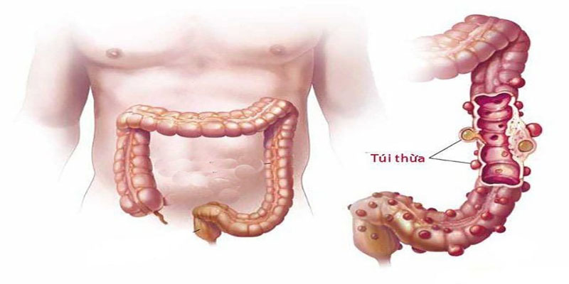 dieu-tri-viem-tui-thua