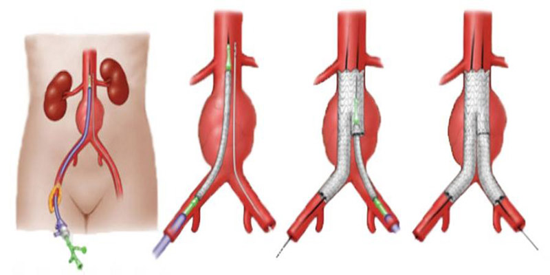 stent-graft